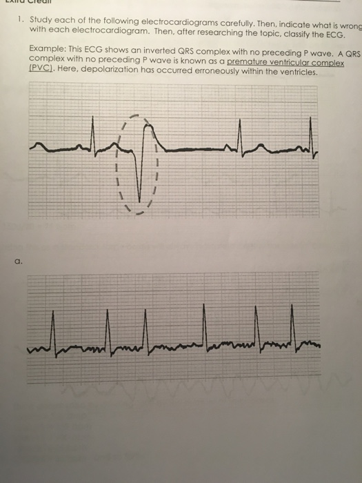 Your Ecg Shows An Inverted Qrs What You Need To Know Now - 6oaokdz