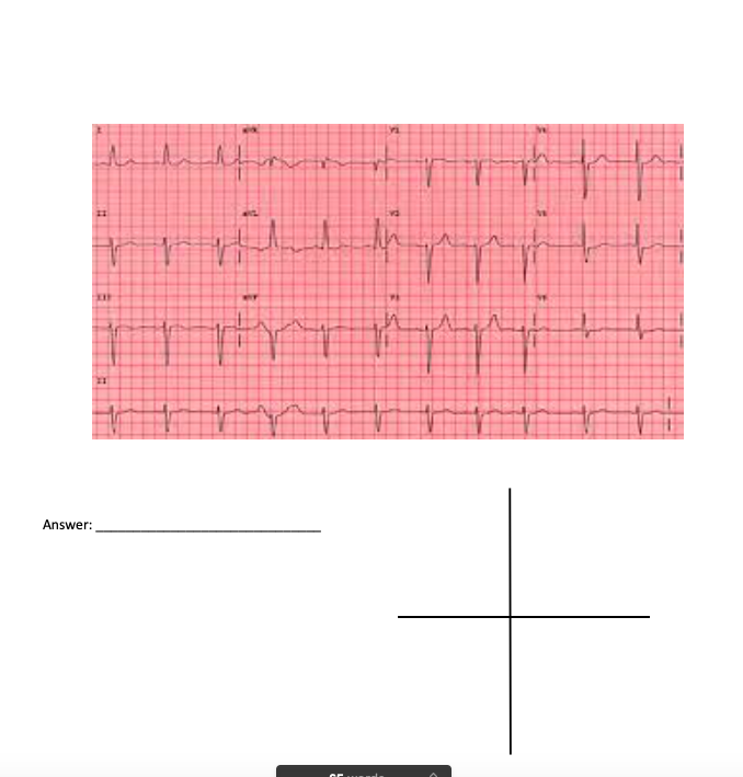 Solved Determine The Axis Of The Following Ekg Use Lead I Chegg