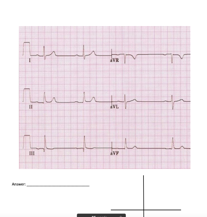 Solved Determine The Axis Of The Following Ekg Use Lead I Chegg