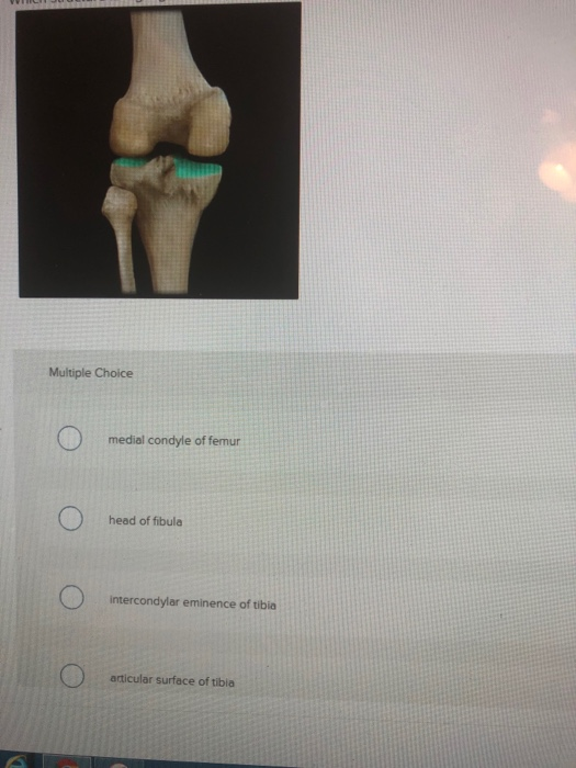 Solved Multiple Choice Medial Condyle Of Femur Head Of Chegg