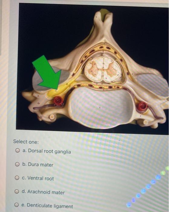 Solved Be Select One O A Thalamus O B Anterior Commissure Chegg