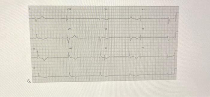 Solved What Is Your Diagnosis For The Following Ekg Strips Chegg