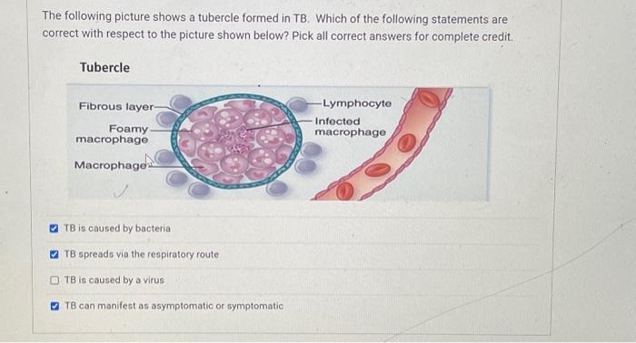 Solved The Following Picture Shows A Tubercle Formed In TB Chegg