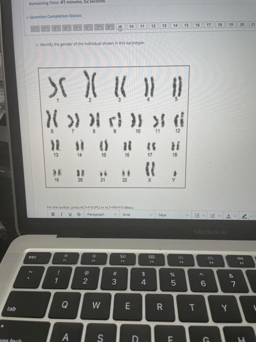 Solved A Identity The Chromosomal Abnormality Trisomy Or Chegg