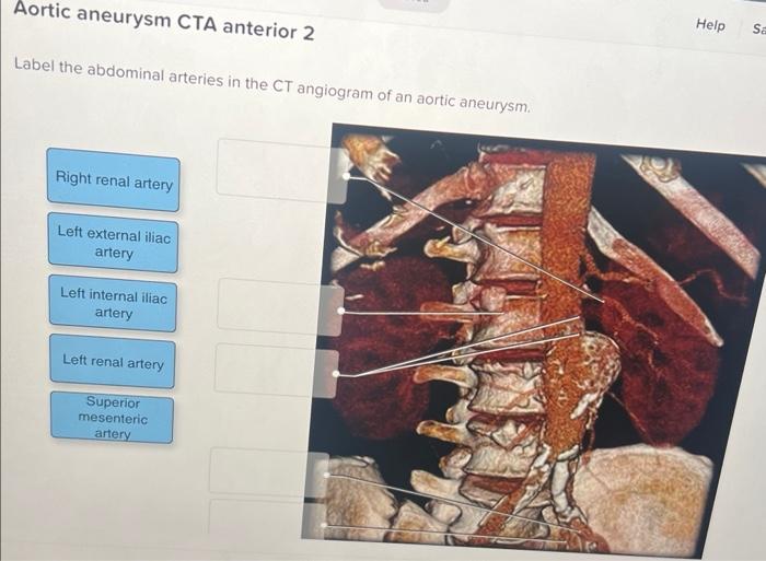 Solved Aortic Aneurysm Cta Anterior Label The Abdominal Chegg