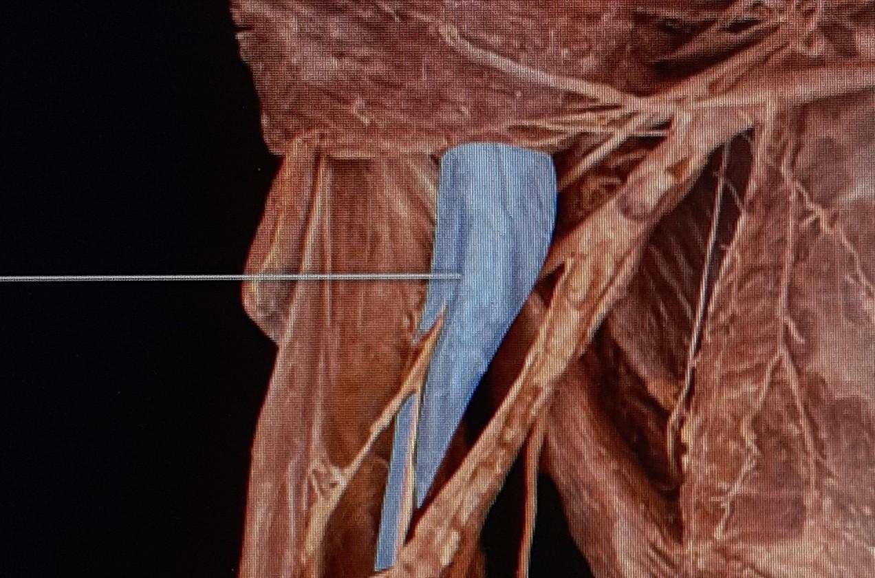 The Highlighted Muscle In Blue Originates From Which Chegg