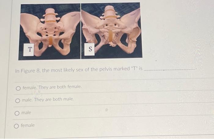 In Figure The Most Likely Sex Of The Pelvis Marked Chegg