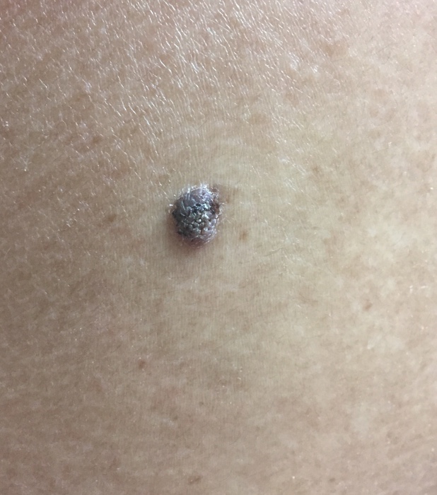 Solved Could This Mole Possibly Relate To Melanoma This M Chegg Com solved could this mole possibly relate