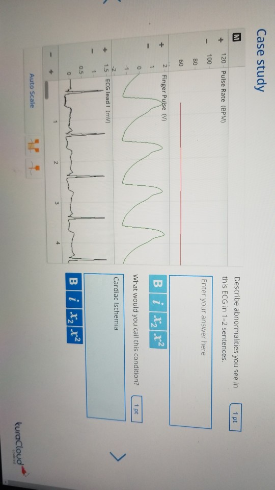 Solved Case Study Describe Abnormalities You See In This Ecg Chegg Com