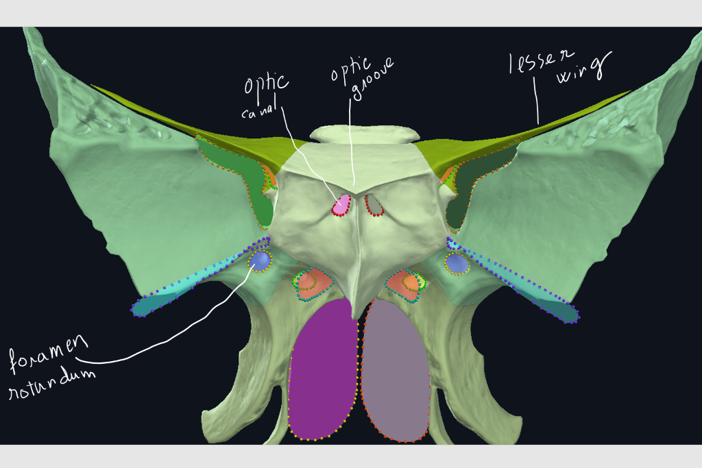 Solved 12 lesser optic optic groove wing canal foramen | Chegg.com