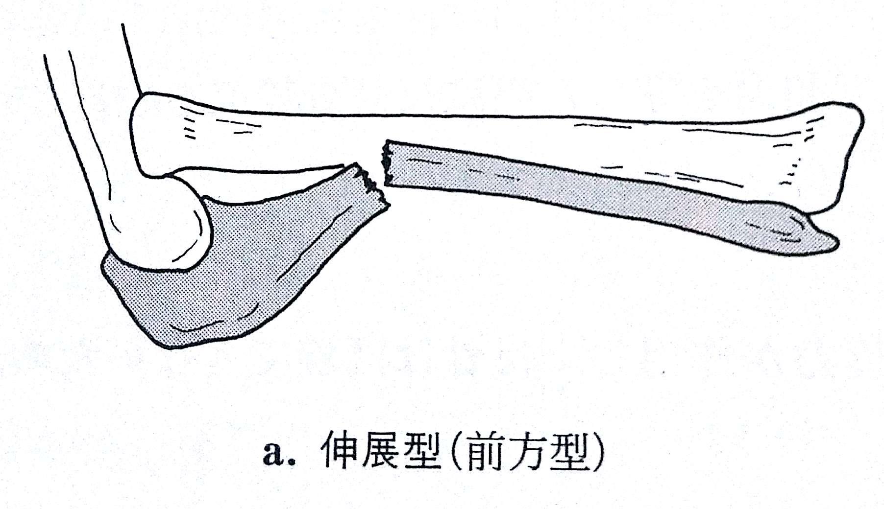 肘 手の骨折脱臼 Flashcards Chegg Com