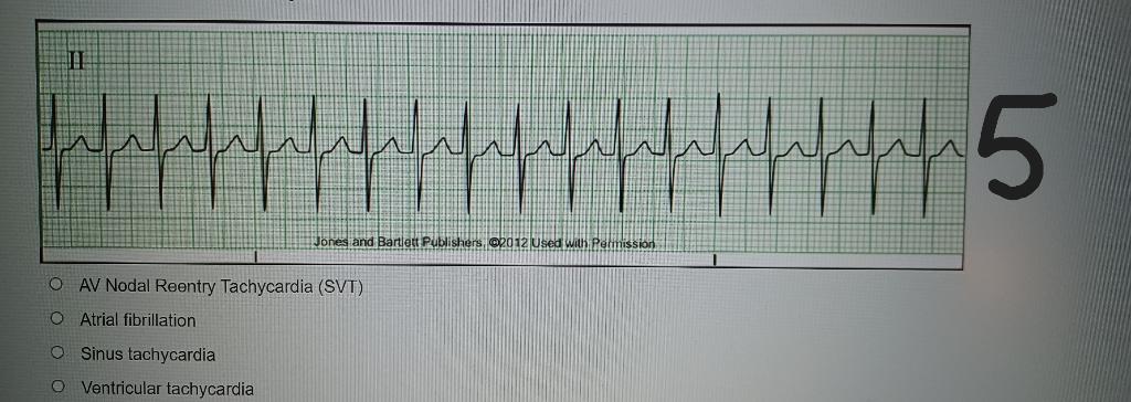 AV Nodal Reentry Tachycardia (SVT)
Atrial fibrillation
Sinus tachycardia
Ventricular tachycardia