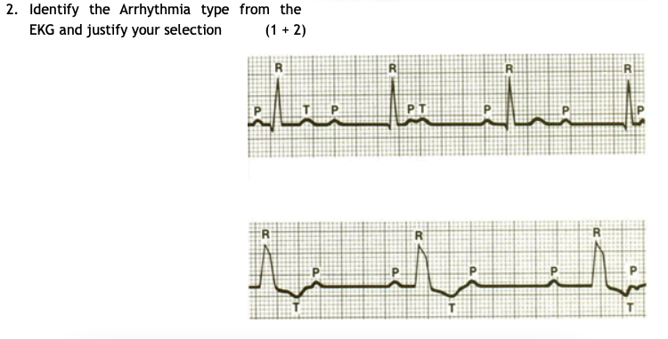 Solved 2. Identify the Arrhythmia type from the EKG and | Chegg.com