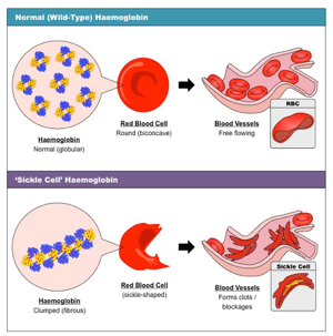 Sickle Cell Hemoglobin Structure