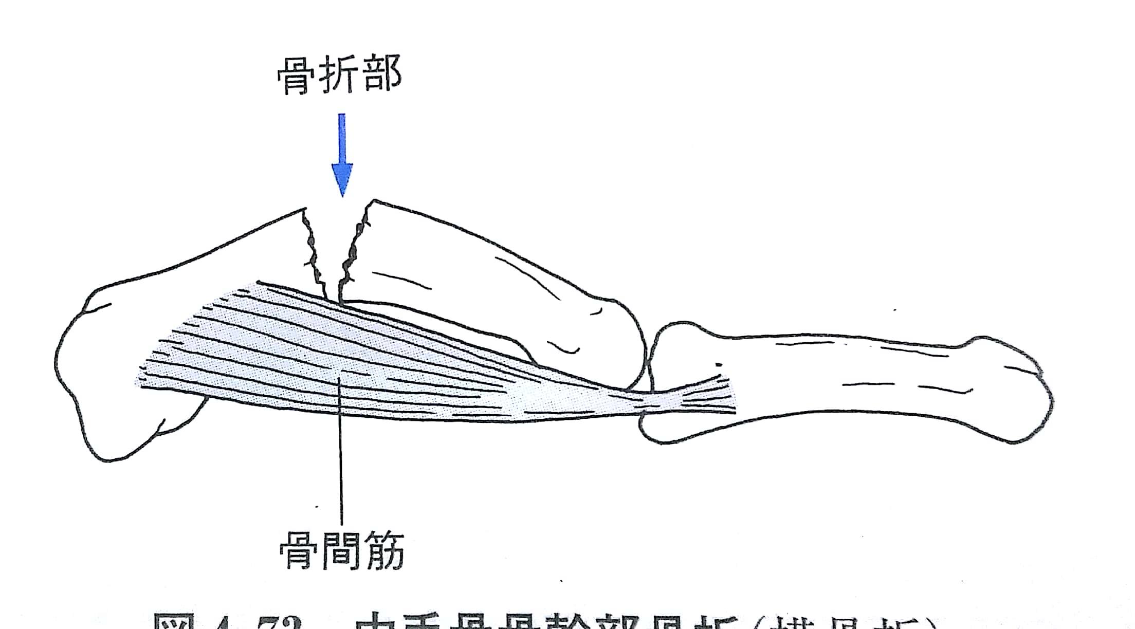 肘 手の骨折脱臼 Flashcards Chegg Com