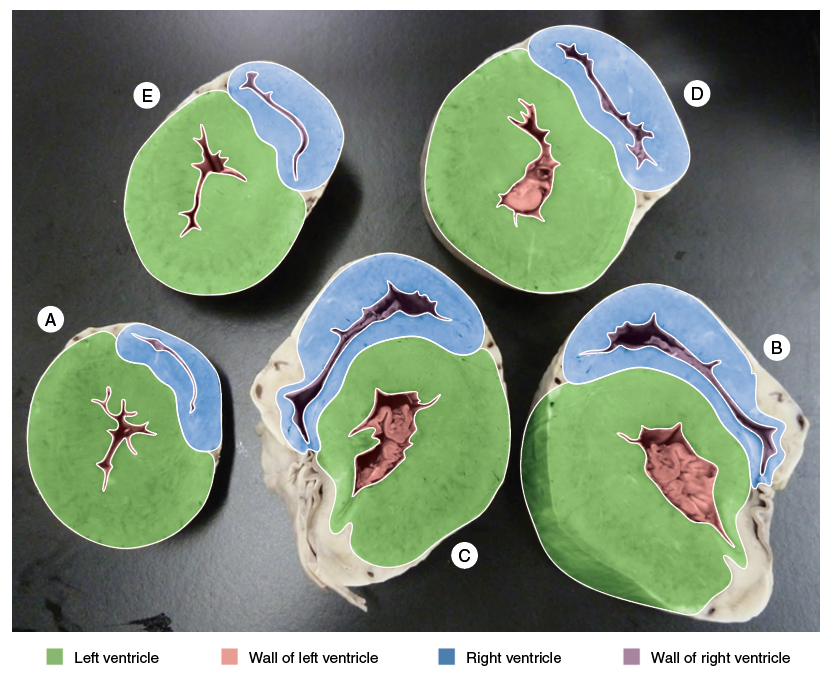 Solved Transverse Sections through the Heart from Apex to | Chegg.com