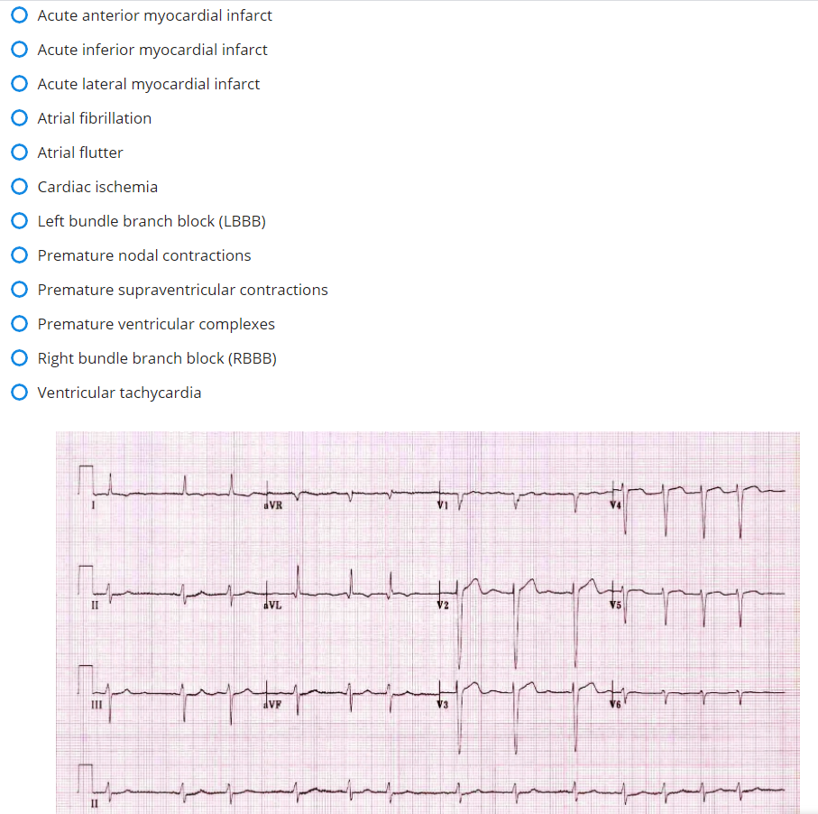 Solved Acute anterior myocardial infarct Acute inferior | Chegg.com