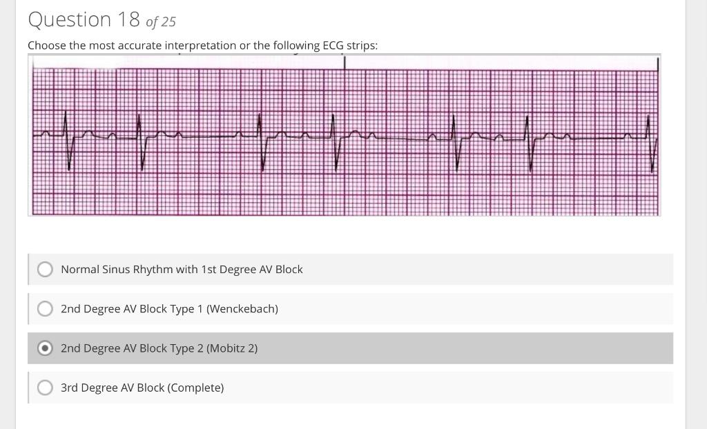 Chonse the most acrurate internretation or the following \( F C G \) strins:
Normal Sinus Rhythm with 1st Degree AV Block
2nd