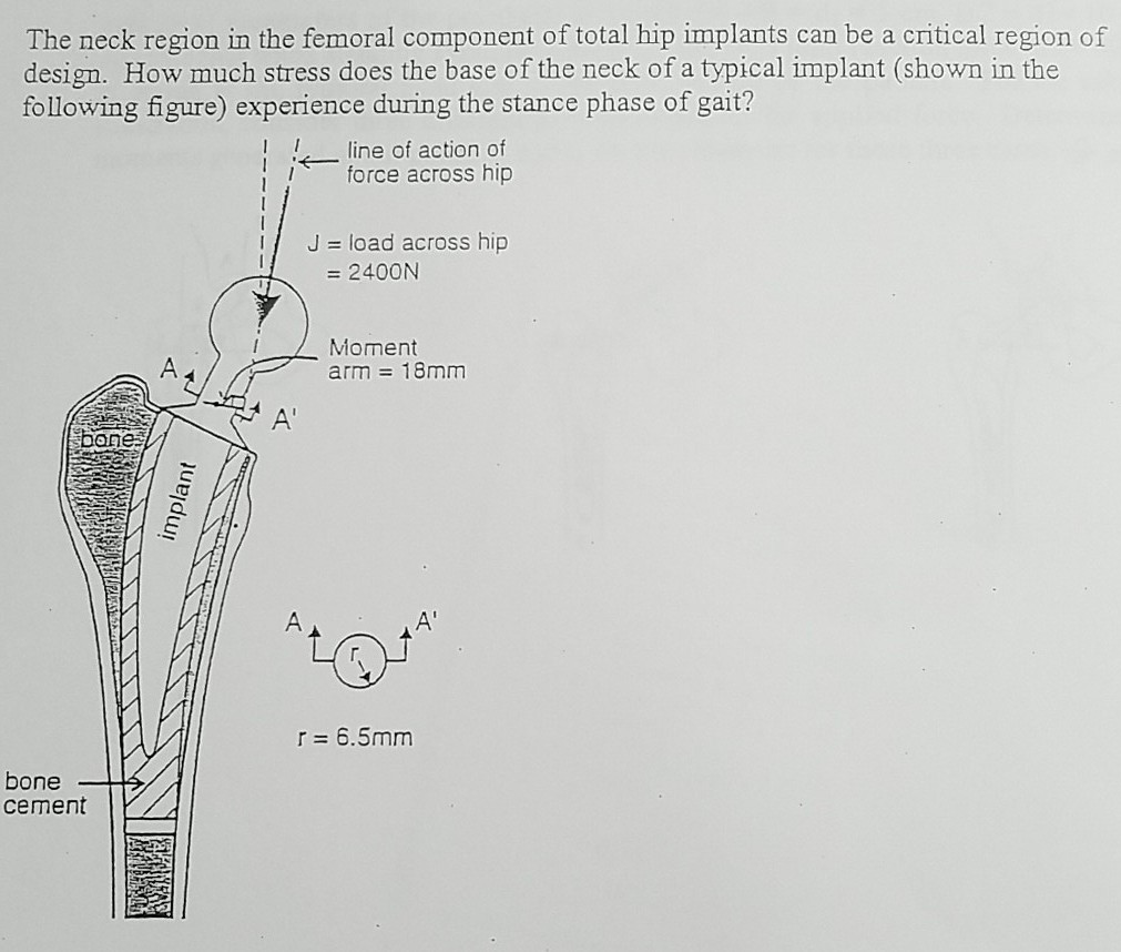 Solved The neck region in the femoral component of total hip | Chegg.com