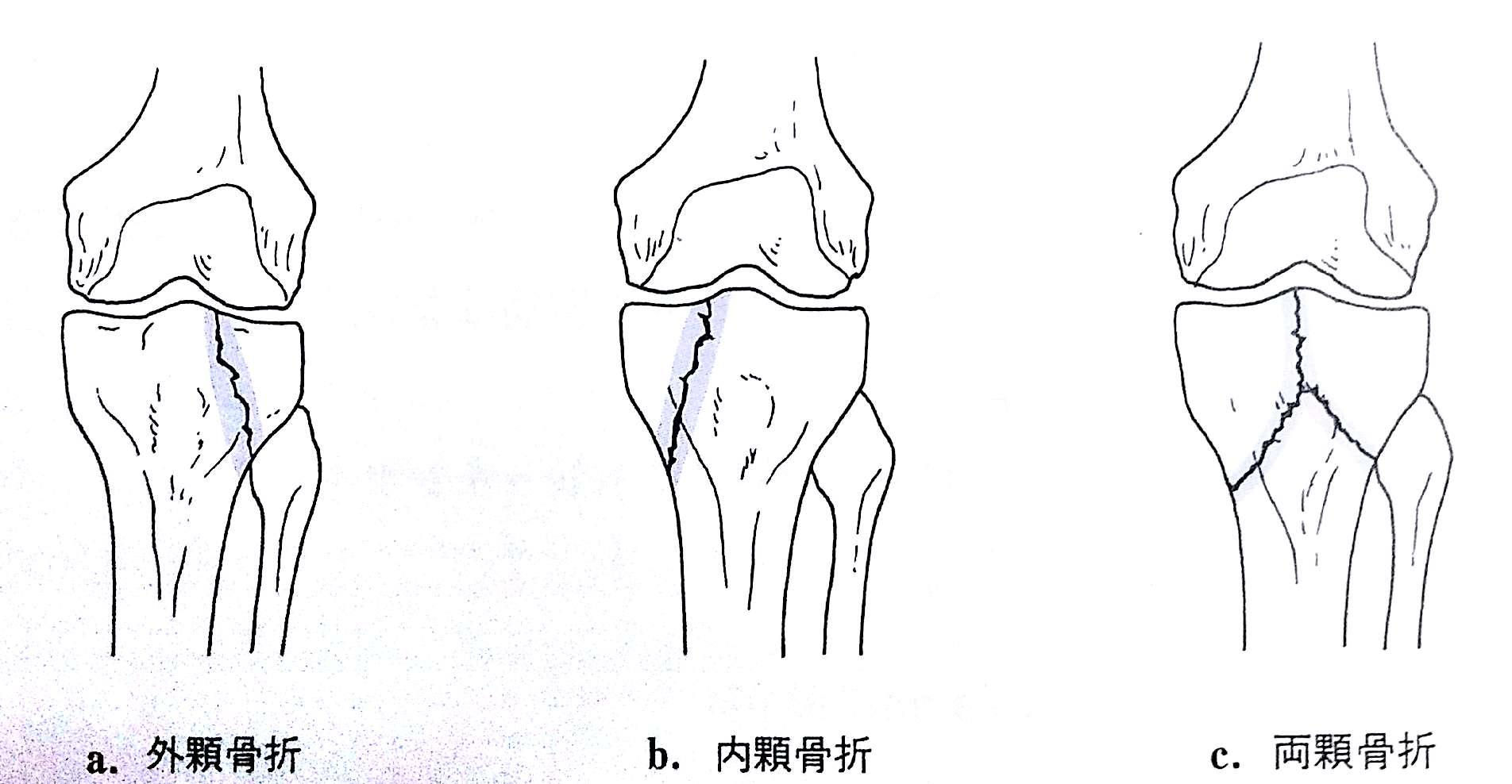 柔整各論 下肢の骨折 下腿骨 足指骨 Flashcards Chegg Com