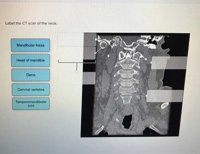 Solved Label the CT scan of the neck. Mandibular fossa Head