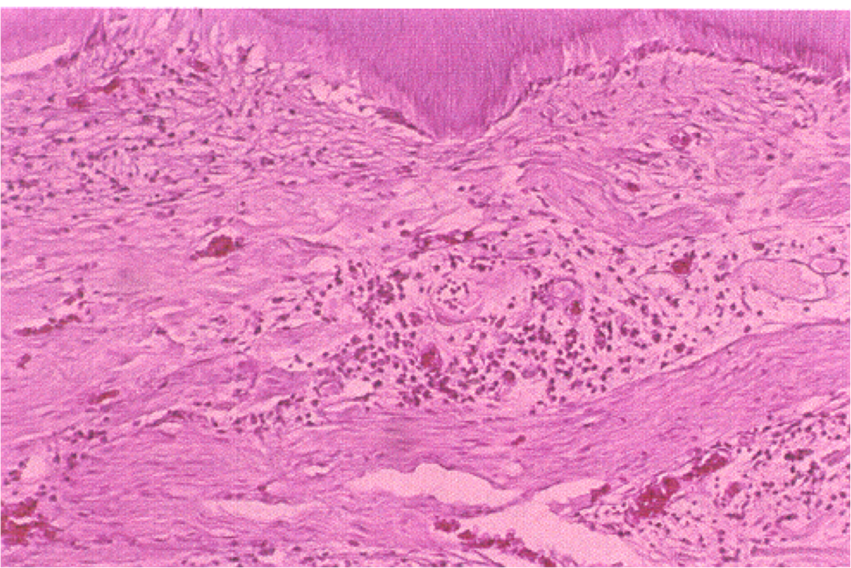 periapical abscess histology