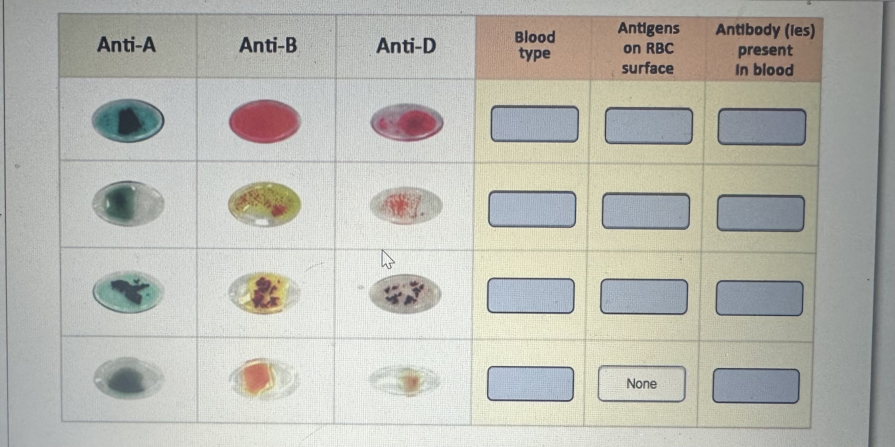 Solved Anti-A Anti-B Blood type Antigens on RBC surface | Chegg.com