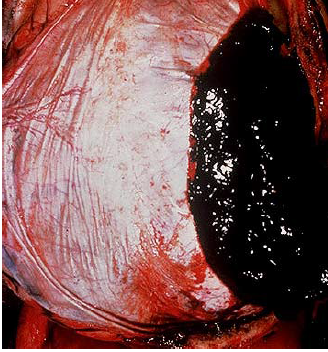 epidural hematoma gross