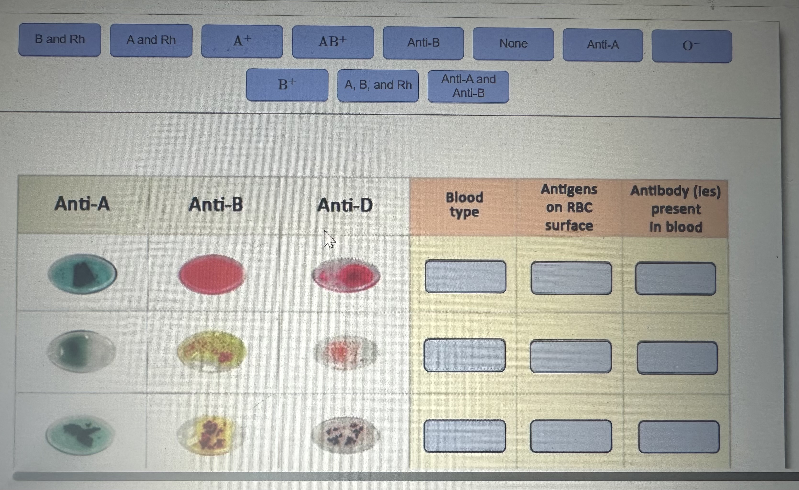 Solved AntiA AntiB Blood type Antigens on RBC surface