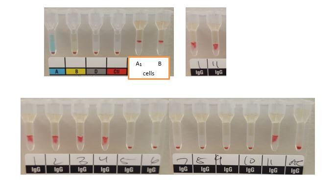 Mary, an OB patient had the following Type, Screen | Chegg.com