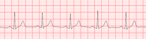 Solved Based on the above ECG, what is the Heart rate? PQRST | Chegg.com