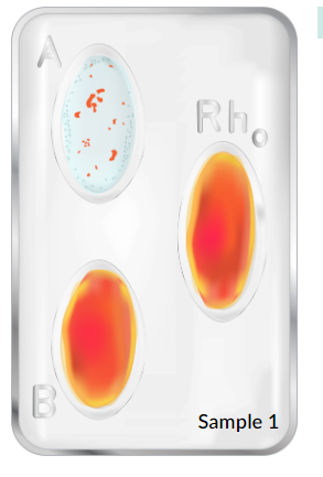 Solved Observation 1: Blood Typing Results | Chegg.com