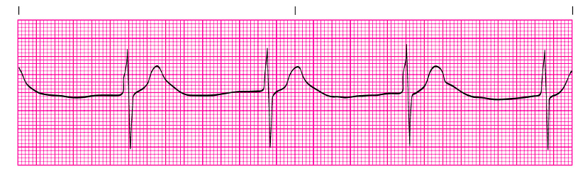 wandering atrial pacemaker rhythm strip