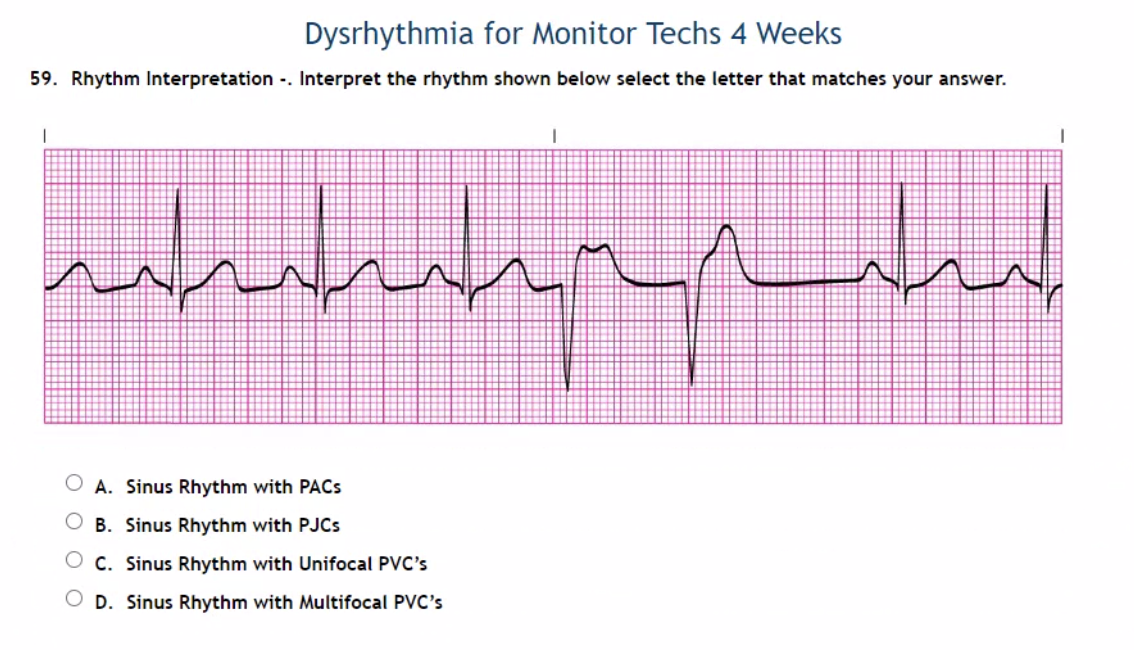 Solved Dysrhythmia for Monitor Techs 4 Weeks 59. Rhythm | Chegg.com