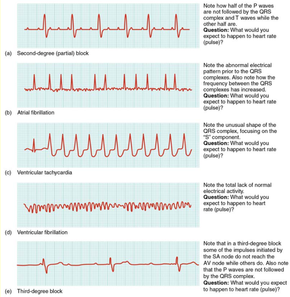 Solved Look at the ECG Abnormalities graphs in Figure 19.25 | Chegg.com