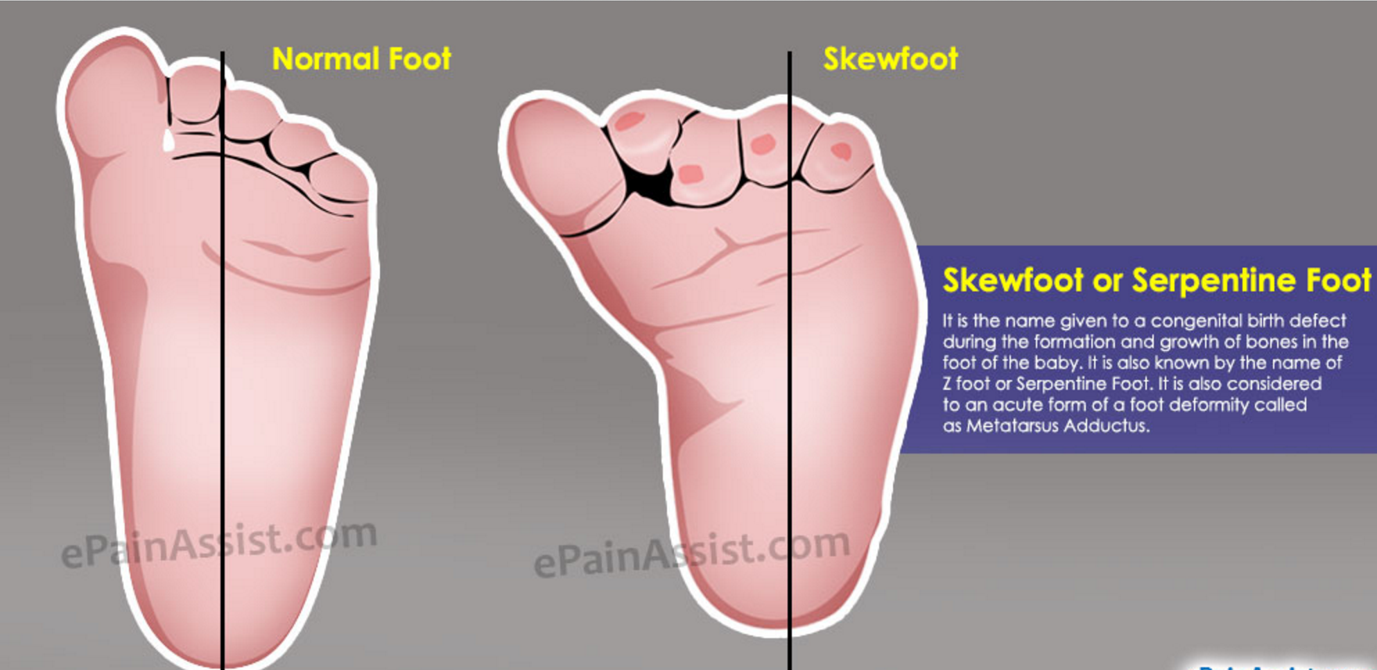 z foot deformity