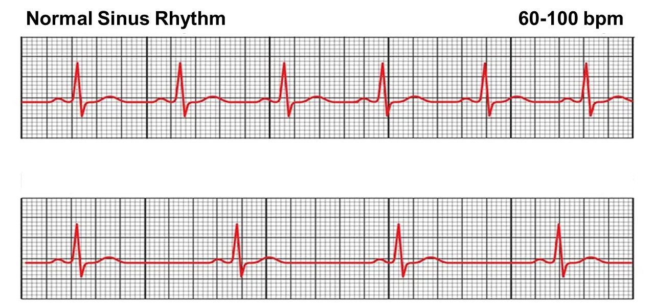 Solved Match The Answers To The Ekg Strips. Please Note The 