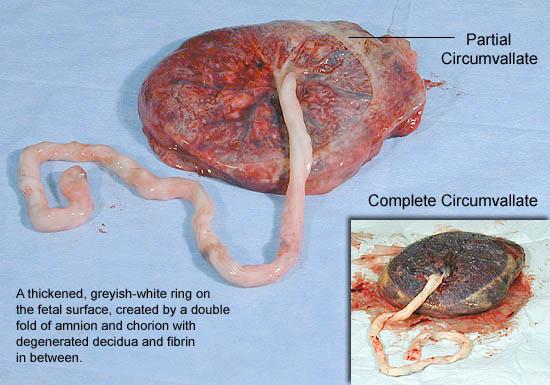 A thickened, greyish-white ring on
the fetal surface, created by a double
fold of amnion and chorion with
degenerated decidua