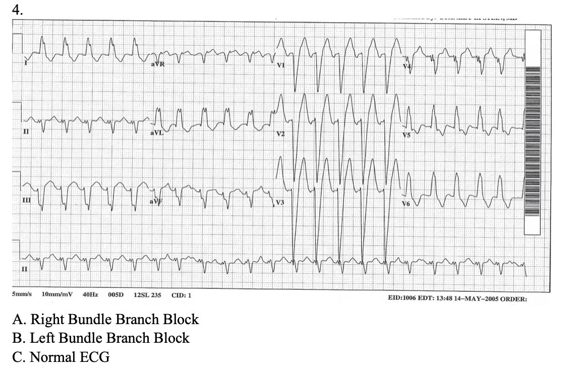 Solved A. Right Bundle Branch Block B. Left Bundle Branch | Chegg.com