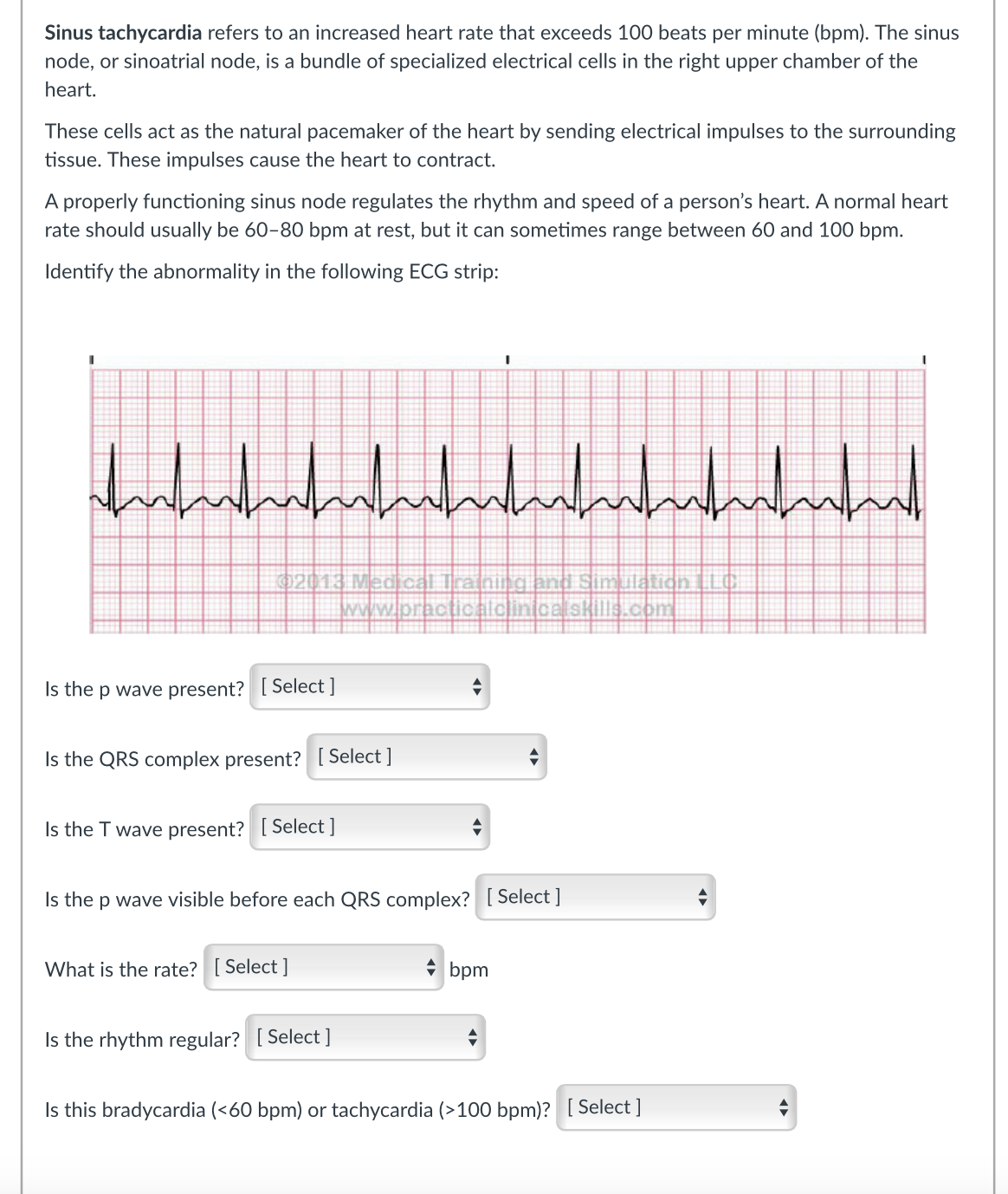 Solved Sinus tachycardia refers to an increased heart rate