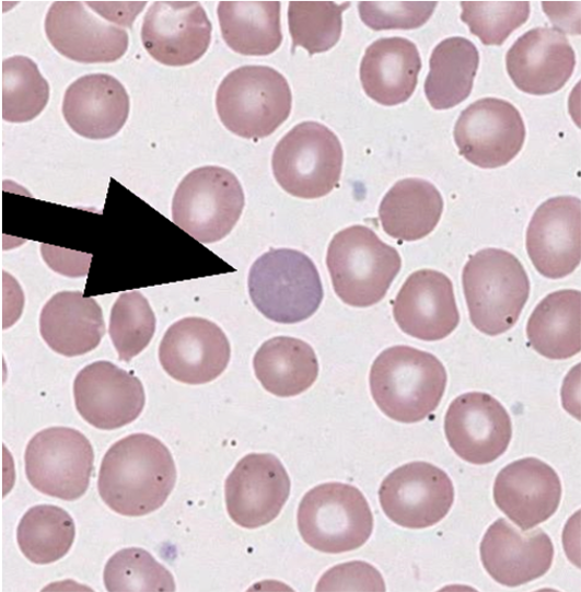 The peripheral blood smear is from a 46 year old | Chegg.com