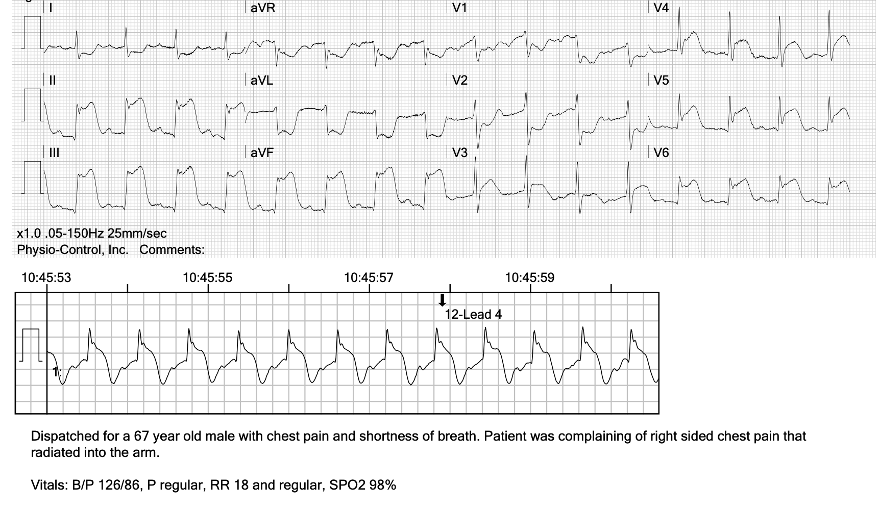 Solved Rate and Rhythm: Q waves: ST-segment | Chegg.com