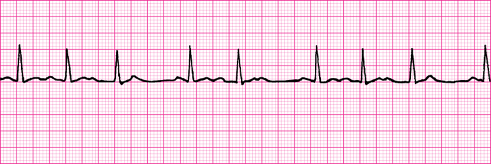 Solved Sinus Rhythm with 2nd Degree Type I | Chegg.com