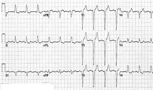 Solved For the EKG tracing given below, calculate the mean | Chegg.com