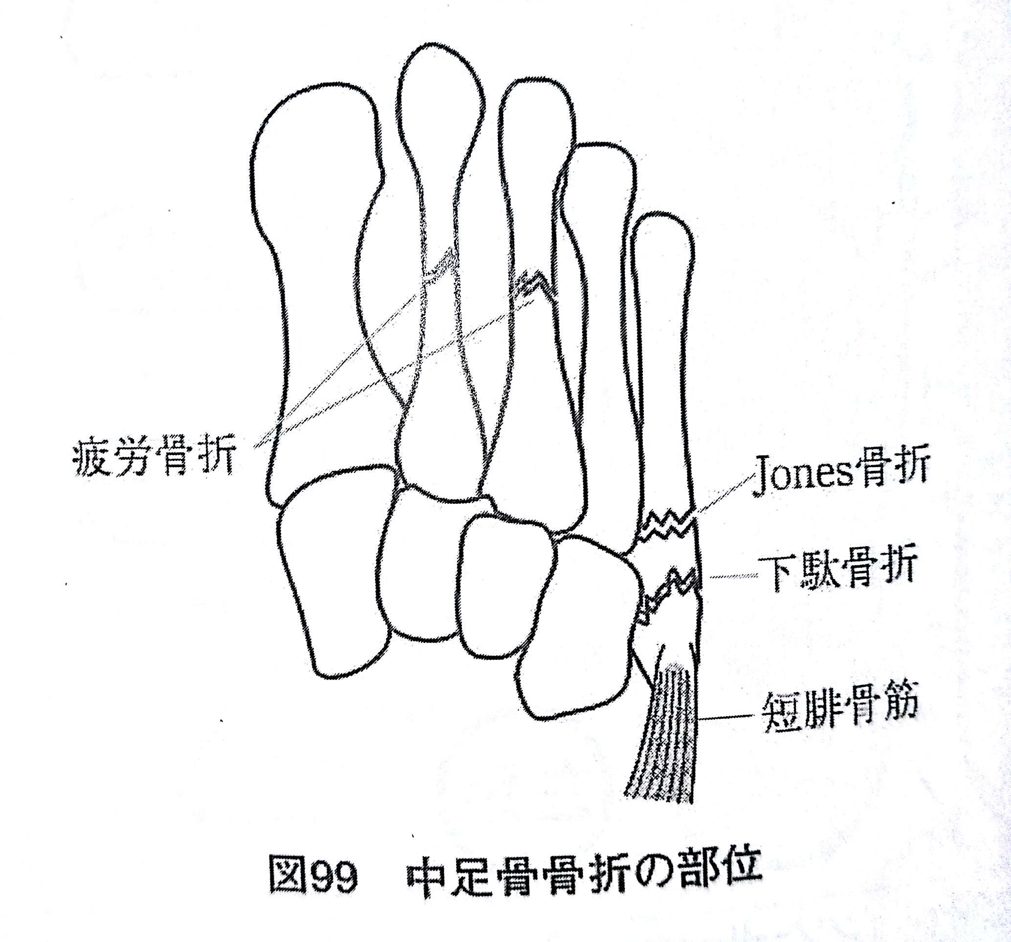 柔整各論 下肢の骨折 下腿骨 足指骨 Flashcards Chegg Com