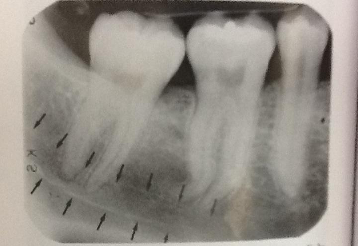 mylohyoid ridge radiograph