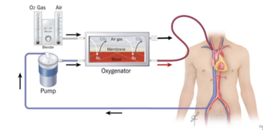 Solved Extracorporeal membrane oxygenation (ECMO) is a | Chegg.com