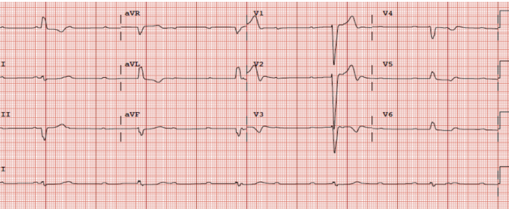 Solved 4 a) Which of the following apply to the ECG Sinus | Chegg.com