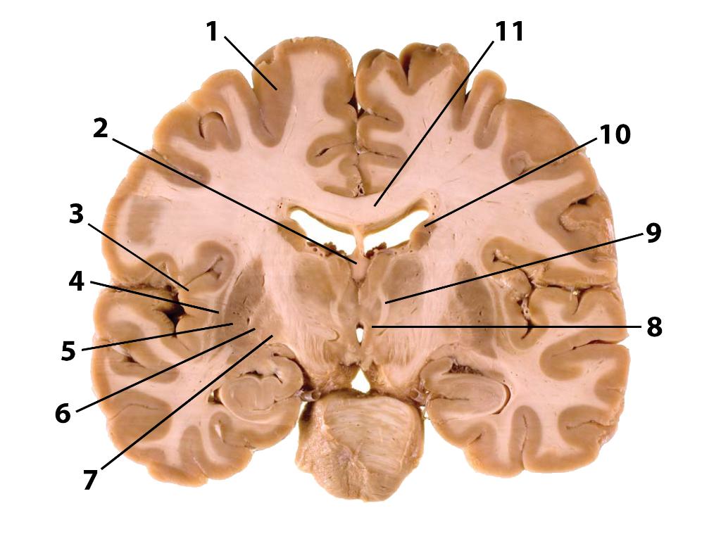 Solved Label all the subcortical gray matter identified by | Chegg.com