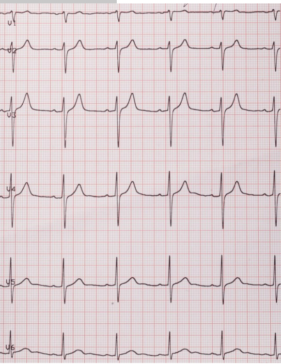 Solved Examine the set of ECG traces below. These were taken | Chegg.com